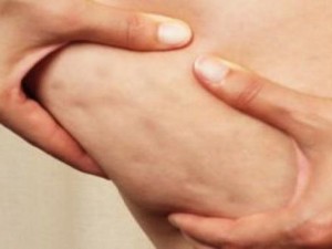 Cellulite. Quali sono i rimedi efficaci per combatterla?