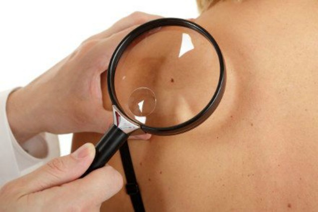 Come evitare il melanoma e come riconoscerlo.