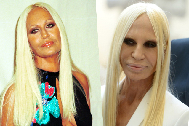 Prima e dopo il botox: le facce distrutte delle celebrities (FOTO).