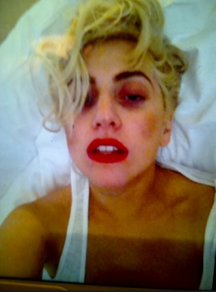 lady gaga contusa dopo l'incidente sul palco
