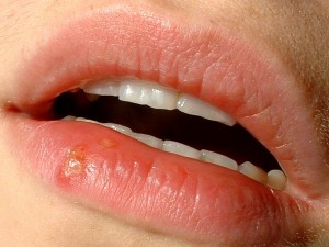 Herpes sempre più diffusa anche a causa del sesso orale.