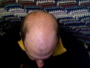 Cura contro la calvizie, capelli clonati sulla schiena dei topi.