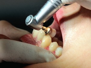 Un'otturazione ai denti le avvelena il sangue. Il legale chiede aiuto.