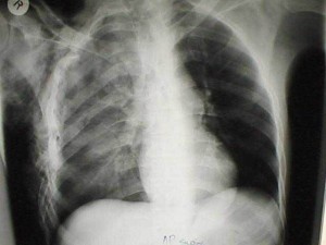 Tumori in crescita come un'epidemia. I più pericolosi secondo l'Oms.