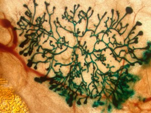 La chemioterapia può rafforzare il cancro!