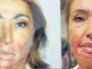 Napoli, sfigurata dopo un intervento di peeling. 