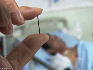 Aveva mal di schiena: i medici gli trovano un ago da agopuntura vecchio 40 anni infilzato nell'intestino.
