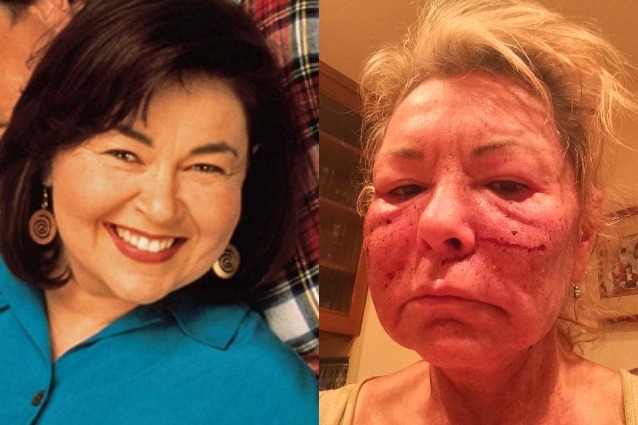 Roseanne Barr sfigurata dal peeling chimico scherza: 