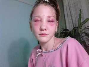 Adolescente resta parzialmente cieca dopo una tintura alle sopracciglia.