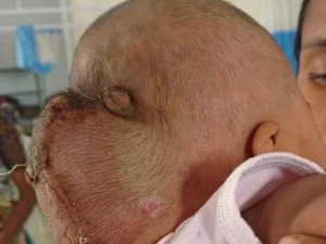 Aveva una cisti che sembrava una seconda testa, bimbo di 5 mesi operato