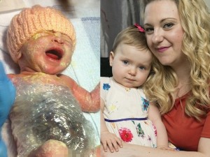 Nata con gli organi fuori dal corpo e salvata con la pellicola, la piccola Millie sta bene