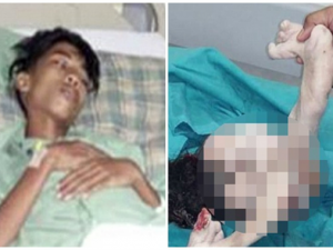 Il bimbo di 15 anni che aveva nello stomaco il feto del suo gemello mai nato