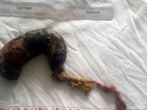 India, ragazza ha una palla di pelo di 3 chili nello stomaco