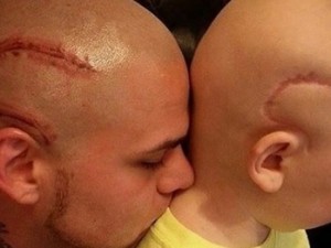 Pap? si fa tatuare in testa la stessa cicatrice del figlio operato al cervello