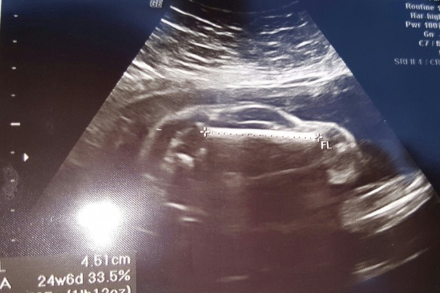 Donna fa l'ecografia e scopre che il bimbo che nascer?... ? una macchinina!