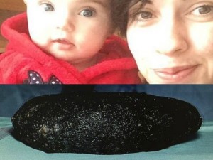 Si strappa i capelli e li mangia: i medici estraggono dal suo corpo una palla di 6 kg