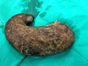 Non riesce a smettere di mangiare i propri capelli: nello stomaco ne aveva oltre un chilo