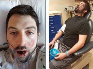 La sigaretta elettronica gli esplode in faccia: perde 7 denti e subisce gravi ustioni