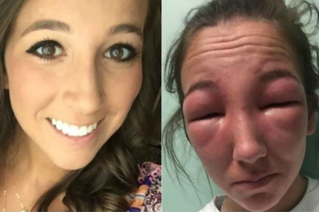 Non riesce ad aprire gli occhi a causa di un'allergia: la sua foto diventa virale