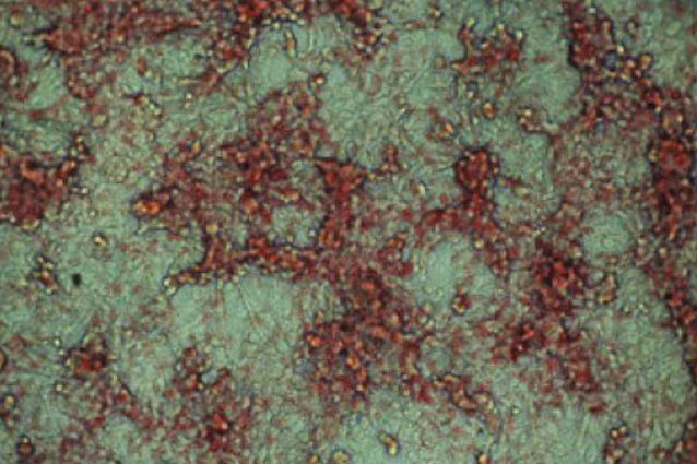 Il 'nemico' del cancro: elimina il grasso e blocca 9 tumori su 10