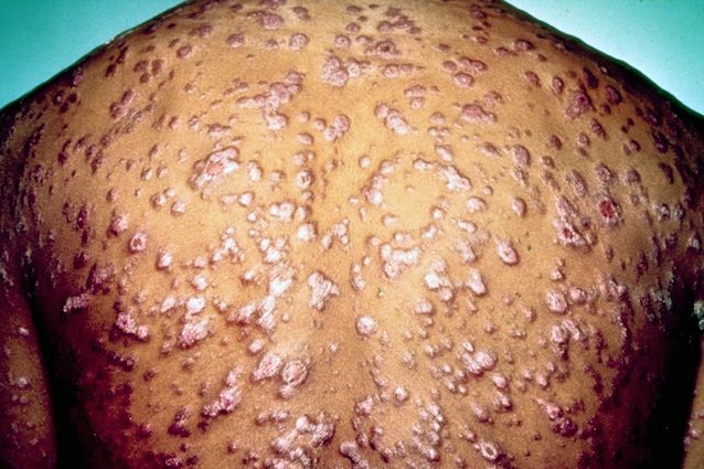Lesioni sui genitali e disturbi neurologici: cos'? la sifilide, quali sono sintomi e cura