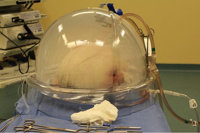 Rigenerato e trapiantato: ecco come i medici italiani hanno recuperato un polmone malato
