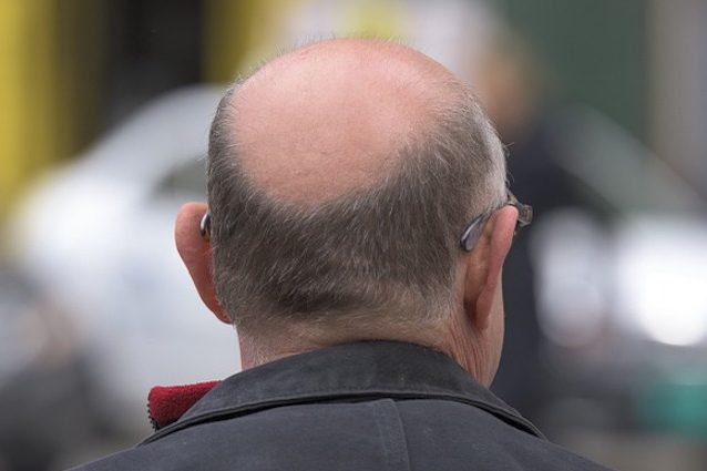 Da una perdita di capelli per capelli unti