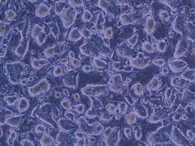Sclerosi multipla, un passo avanti nella terapia staminale