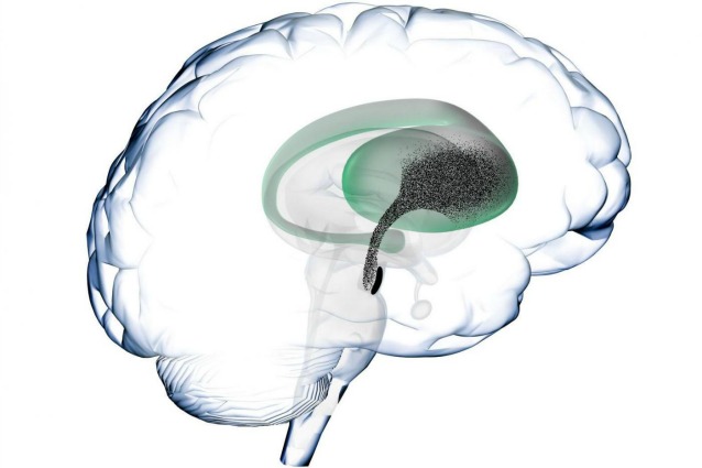 degenerazione della substantia nigra