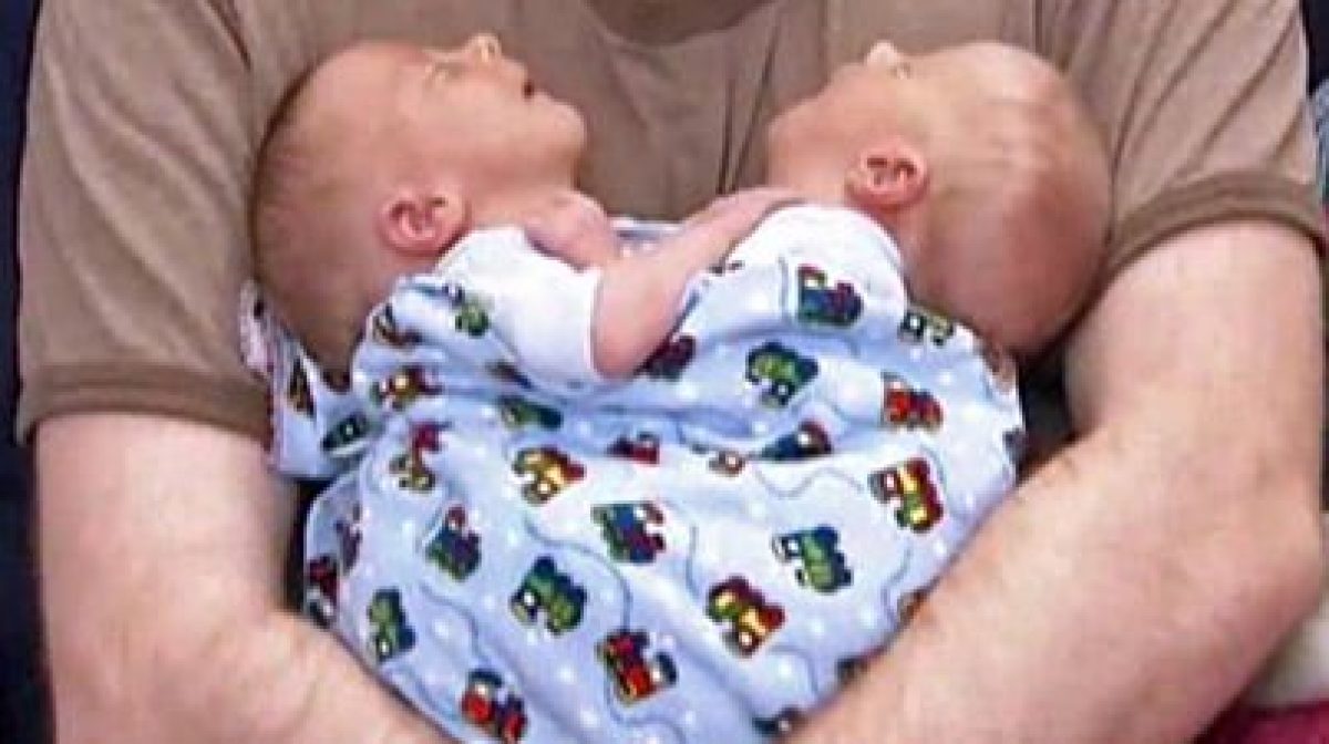 USA, gemelli siamesi condividono cuore e fegato. I genitori Non li