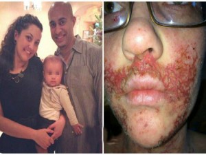Una malattia le impedisce di abbracciare il figlio. ?Gratto via la pelle con le forbici?