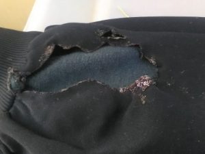 La batteria del telefono le esplode in tasca : ustioni di terzo grado per una donna di Ferrara