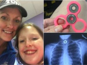 Un pezzo del Fidget Spinner le finisce in gola: bimba di 10 anni rischia di soffocare