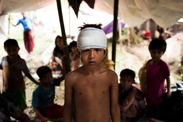 Un bambino ferito nel campo profughi allestito a Kutupalong nel Bangladesh (Unicef)
