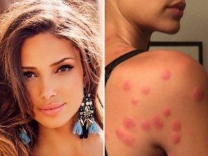 Si sveglia con 90 morsi di cimici sul corpo, la modella fa causa all’hotel in California