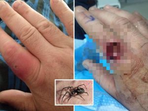 “Poteva uccidermi”, 37enne perde quasi un dito dopo il morso di un ragno