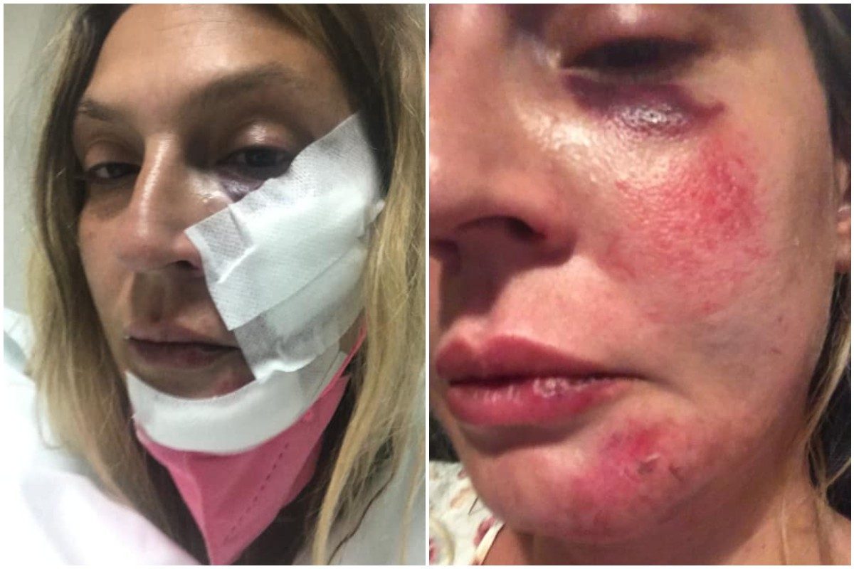 Ricercatrice, in vacanza in Calabria, aggredita da 4 persone per aver soccorso alcuni cani randagi - Vimarsana News