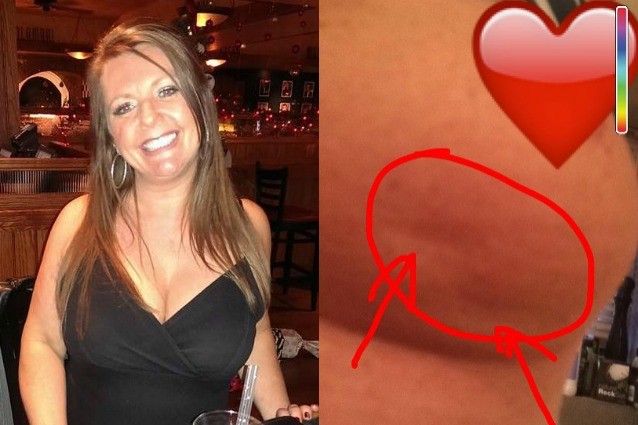 Scopre di avere il cancro e mostra i segni che ha sul seno su Facebook