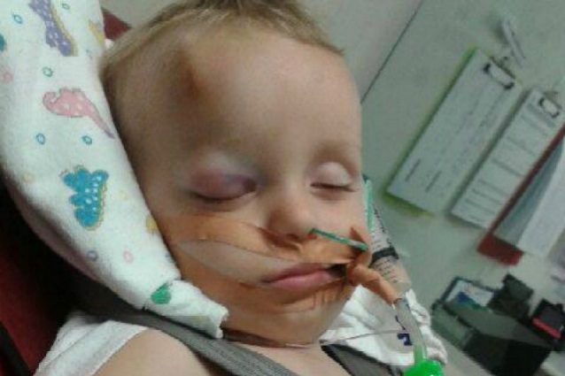 Dopo una caduta dal divano i medici gli rimuovono metà del cranio: la battaglia del bimbo