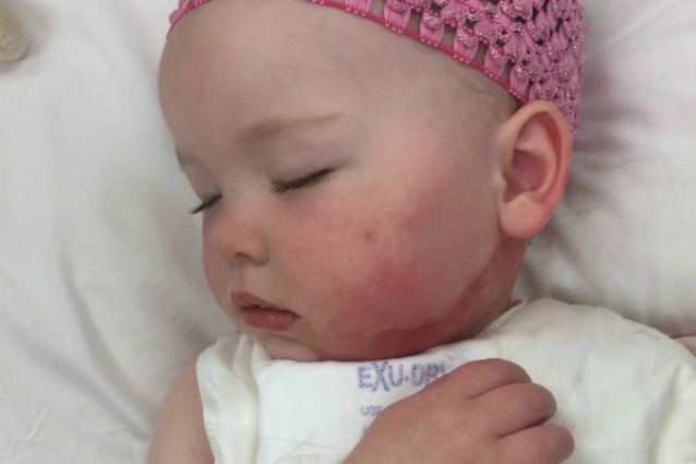 Si versa dell'acqua bollente sul corpo, a 21 mesi la bimba è ricoperta di ustioni