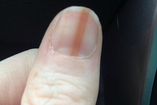 Ricorre alla manicure in gel, le compare un melanoma sull'unghia