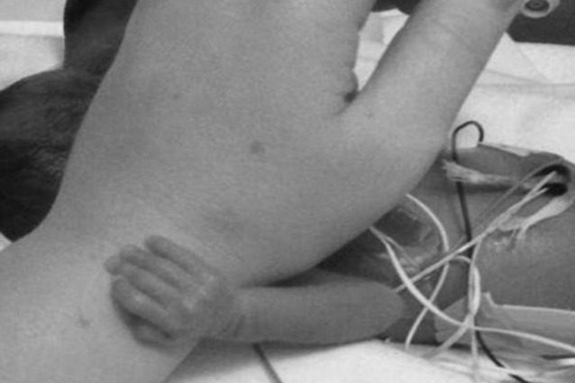 La forza di una bimba prematura: si aggrappa alla mano dell'infermiera con tutte le forze
