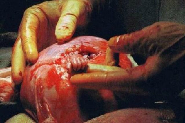 Ecco com'è diventato Samuel, il bimbo famoso per la sua "Mano della speranza"