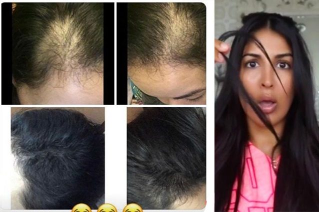 Vitamine A di perdita di capelli ed e dimeksid