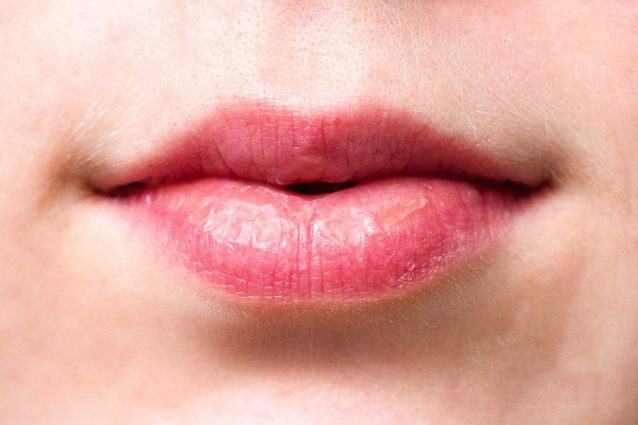 Rischia la vita con il trattamento per avere labbra carnose: "La bocca mi è esplosa"