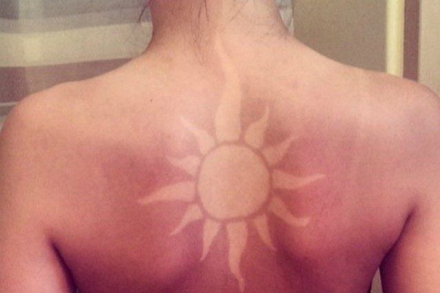 Scottature Solari 11 Rimedi Naturali Per Guarire Velocemente