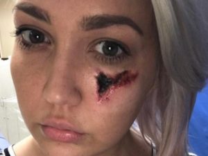 Il volto di Meghan Linsey dopo il morso del ragno (via Instagram)