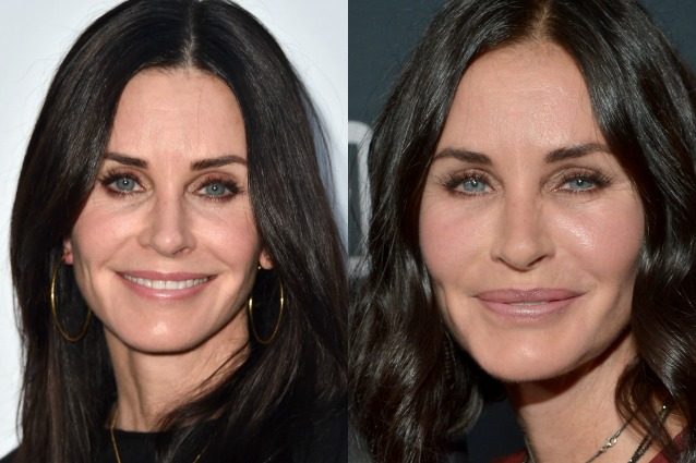 A sinistra, Courteney Cox oggi. A destra, l'attrice sfigurata dal botulino nel 2015.