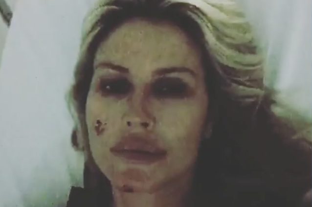 Nathalie Caldonazzo pubblica video con le ferite dell'incidente