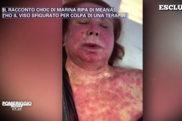 Marina Ripa di Meana con il volto sfigurato: “Sfregiata da una terapia contro il cancro”